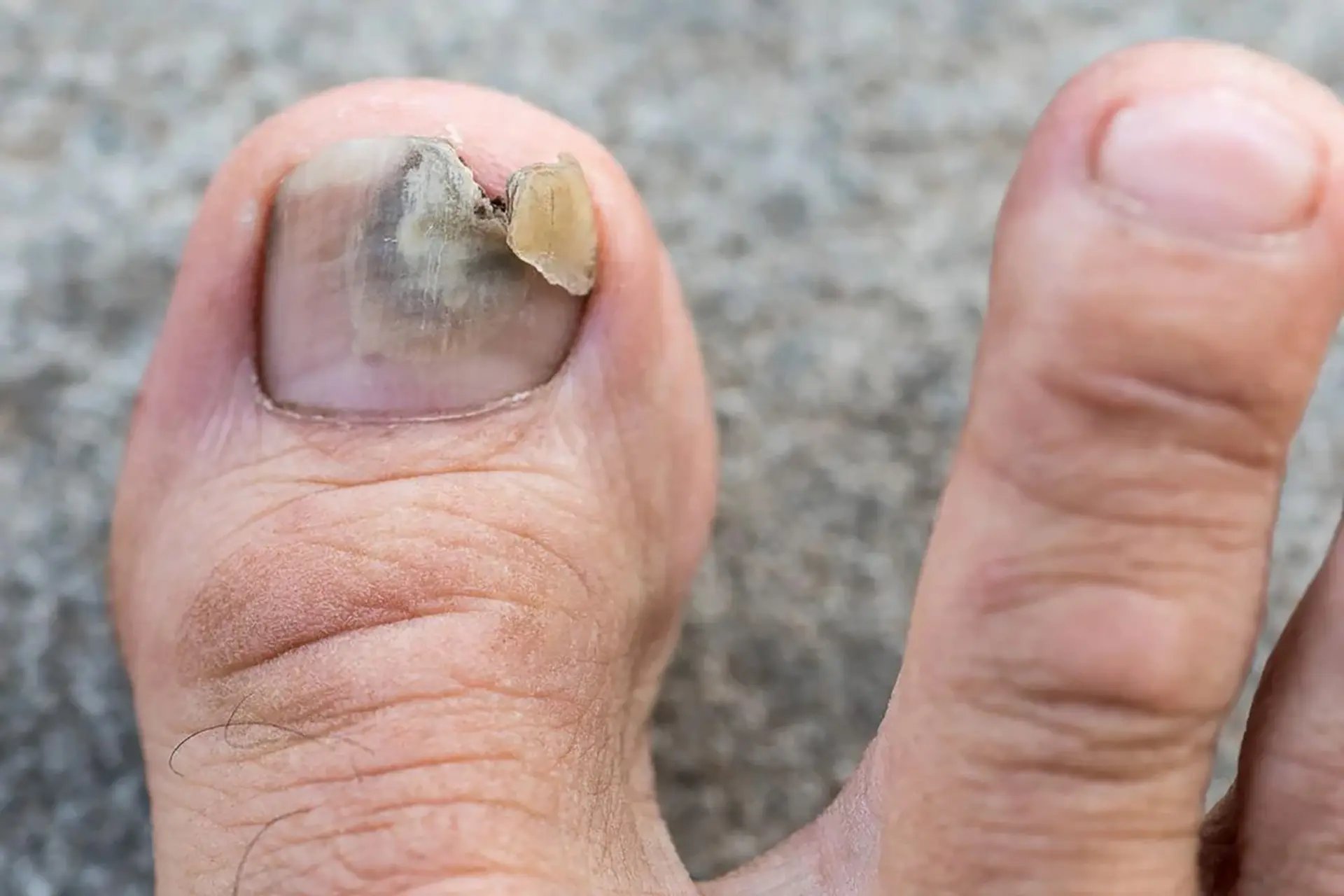 Why toenail fungus keeps returning video presentation